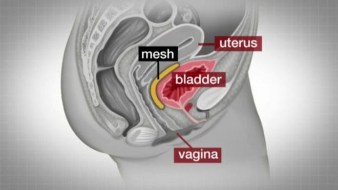 Графика, показывающая, как работает вагинальный сетчатый имплант