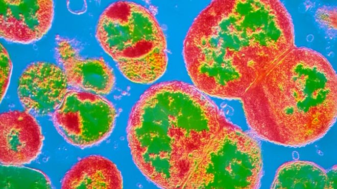 A micrograph of the bacteria that causes gonorrhoea