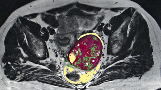 Сканирование рака яичников