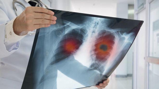 Un doctor examina una radiografÃ­a con cÃ¡ncer de pulmÃ³n.