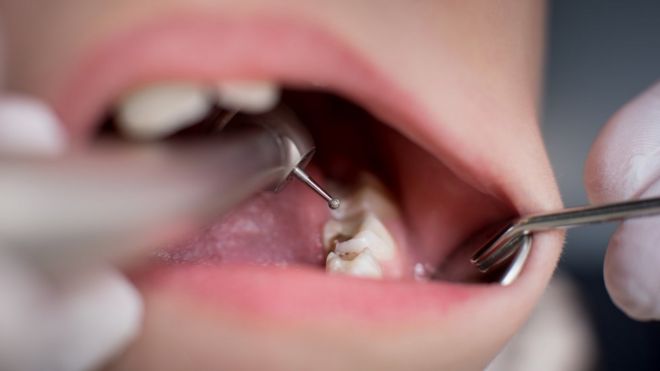 Стоматолог работает на зубы пациента