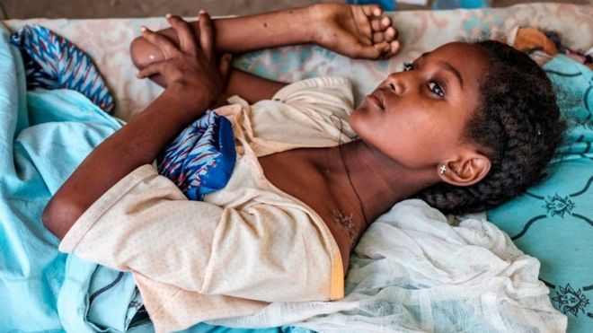 A young girl recovers from her wounds at her house, in Humera, Ethiopia, on November 22, 2020