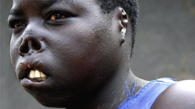 Бывшая угандийская похищенная Армия сопротивления Бога в 2005 году, когда ей было 17 лет, несет шрамы от своей встречи