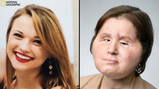 Imagem mostra dois momentos de Katie Stubblefield, a mais jovem americana a passar por um transplante de rosto. À esquerda, ela aparece sorridente, antes da tentativa de suicídio que a fez perder grande parte do rosto. À direita posa com sua nova face, recebida de uma mulher que havia morrido três dias antes.