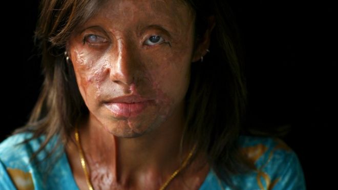 Сайра Лиакат, 22 года, жертва кислотного насилия, сожженная 4 года назад, позирует в Исламабаде, 11 июня 2007 г.