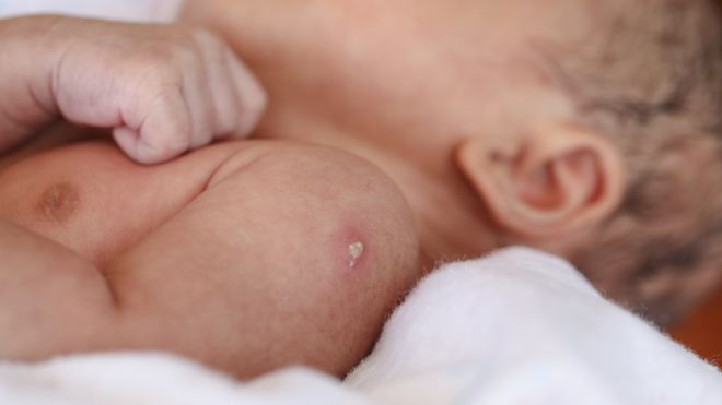 Bebé con la cicatriz característica de la BCG en el brazo.