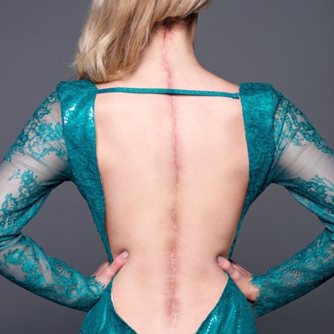 Victoria poses in an open ball gown showing a 25 inch scar from her surgeries down her spine