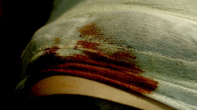 cintura de un adolescente con vendajes manchados de sangre