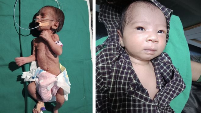 Uma foto da bebê recebendo soro no hospital e outra onde aparece já saudável