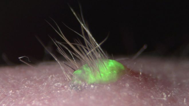 transplanted cells with hair growing from them