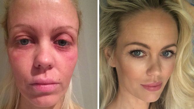 Before and after Malene had her implants removed