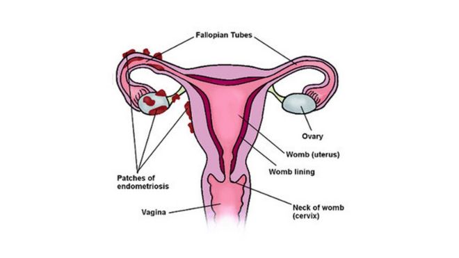 Диаграмма, показывающая, как эндометриоз накапливается вокруг маточных труб и яичников