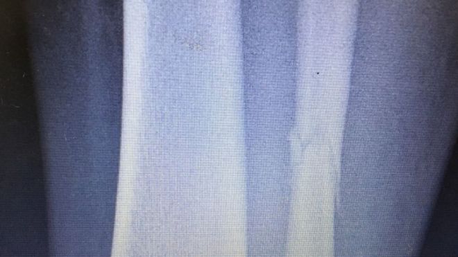 Рентген сломанной ноги Клэр