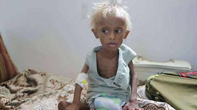 صدمت حالة الطفل اليمني سليم العالم قبل سنة لما بدا عليه من هزال بسبب الجوع الذي يهدد نصف أطفال اليمن. فأين هو سليم الآن؟ وماهي الجهود القائمة لإنقاذ أطفال اليمن؟