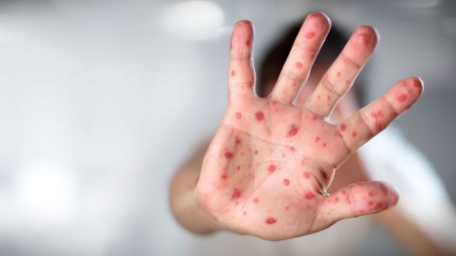 Hand with measles