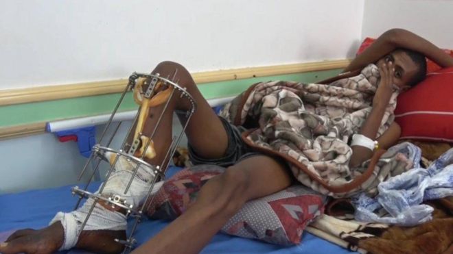 Un migrante con una pierna lesionada yace en una cama de hospital en la ciudad yemení de Saada.