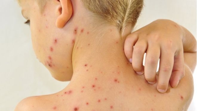 Herpes Zoster La Otra Enfermedad Que El Virus De La Varicela Te