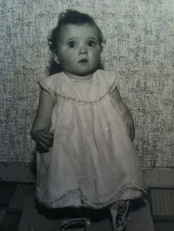 Старая фотография Ким Фентон в детстве. Она родилась с укороченными руками и ногами, деформированными руками, без больших пальцев, без коленных чашечек и перевернутых ног.