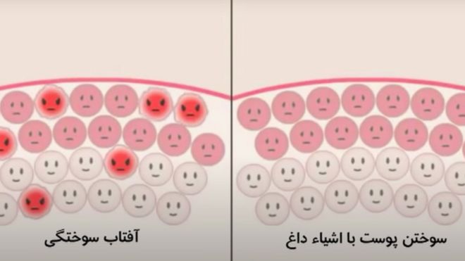 بدون کرم ضد آفتاب هر کسی چقدر می‌تواند زیر آفتاب بماند؟