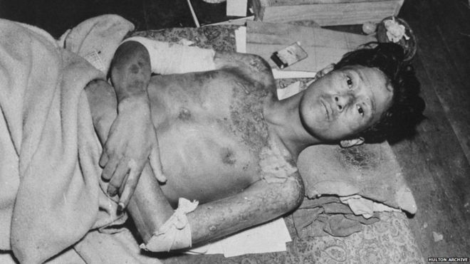 Жертва взрыва атомной бомбы в 1945 году над Нагасаки, Япония.