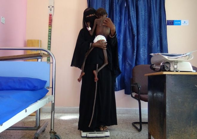 الأم اليمنية نادية نهارى تحمل ابنها عبد الرحمن مانهاش، البالغ من العمر خمس سنوات، الذي يعاني من سوء تغذية حاد