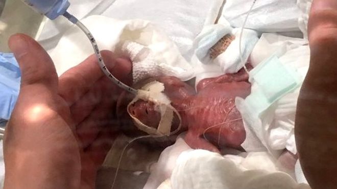 Bebê nascido prematuro