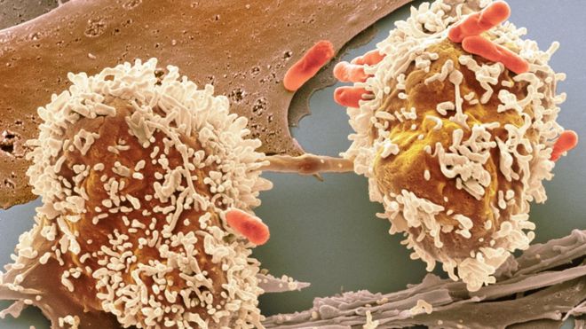 раковые клетки кишечника