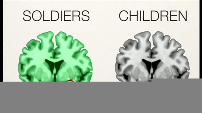 虐待受けた子どもとPTSD兵士の脳が類似＝研究