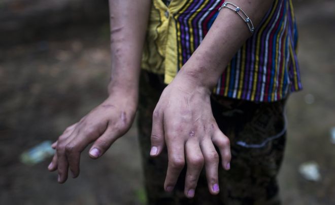 San Kay Khine akionyesha alama na majeraha mikononi mwake