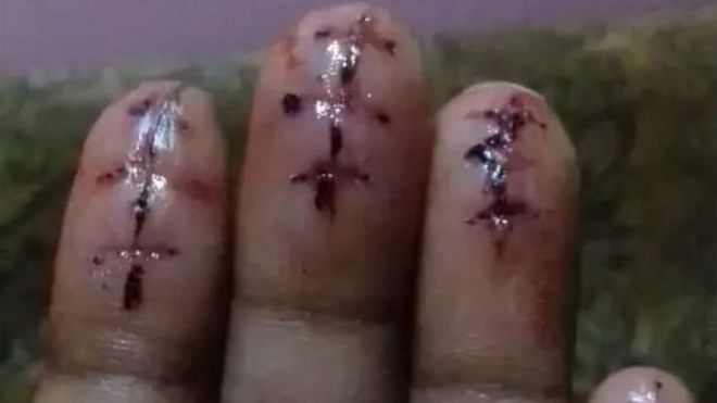 விரல்களில் அறுவை சிகிச்சை