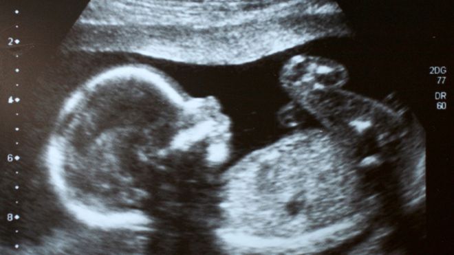 Ultrazvuk fetusa