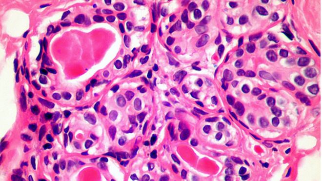 سلول های سرطان سینه