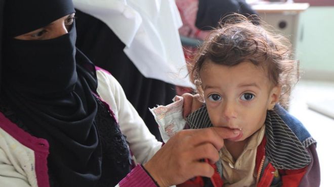 A 14-month-old child receives treatment for malnutrition in Amran, Yemen, 16 August 2018