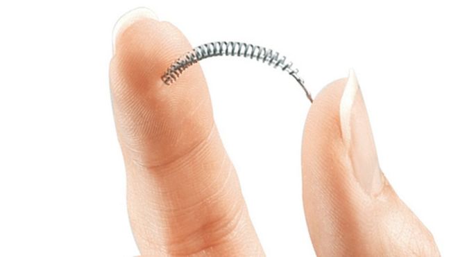 Устройство Essure