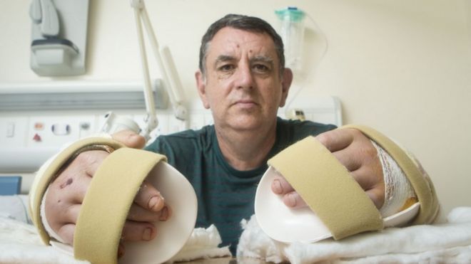 O britânico Chris King depois do bem sucedido transplante duplo de mãos