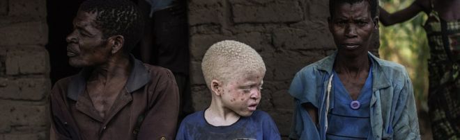 Ребенок-альбинос в Малави сидит между родителями