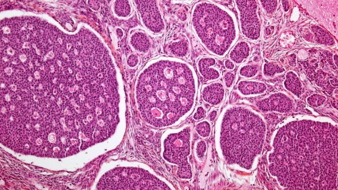 Ovarian cancer
