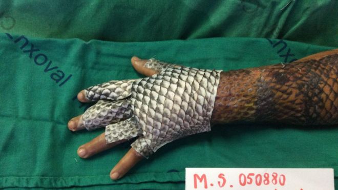 Pele de tilápia aplicada em paciente com queimaduras