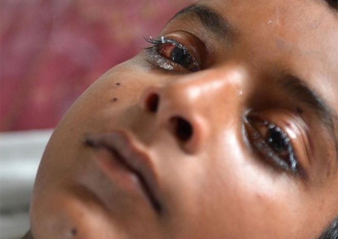 Раненый кашмирский мальчик с поврежденным глазом лежит на больничной койке после того, как 13 июля 2016 года в больнице в Сринагаре пострадали гранулы, выпущенные индийскими силами безопасности во время акции протеста