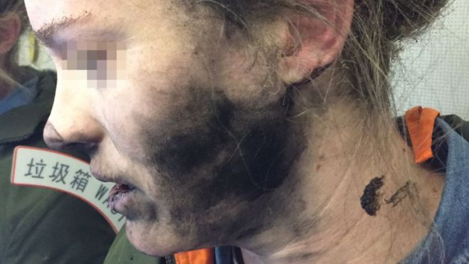 Detalhe do rosto da mulher cujo celular explodiu