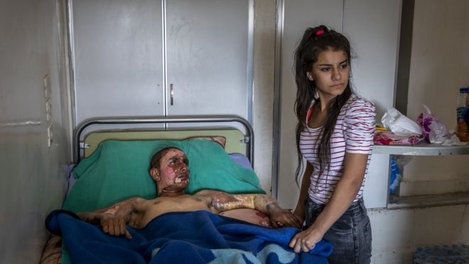 Ahmed Ibrahim, de 18 años y miembro de las Fuerzas democráticas de Siria, gravemente quemado, recibe la visita de su novia en un hospital en al Hasakah (Siria), el 20 de octubre de 2019.