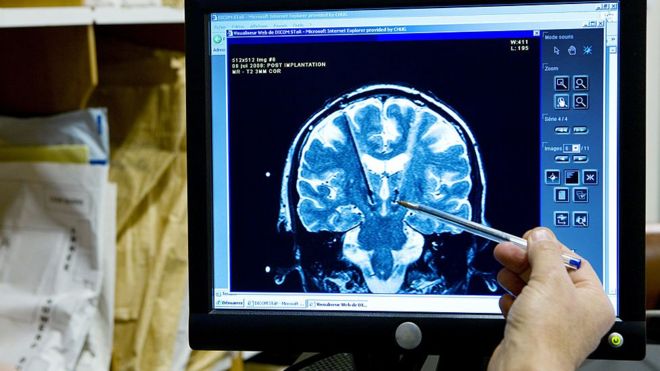 Beyin tomografisi