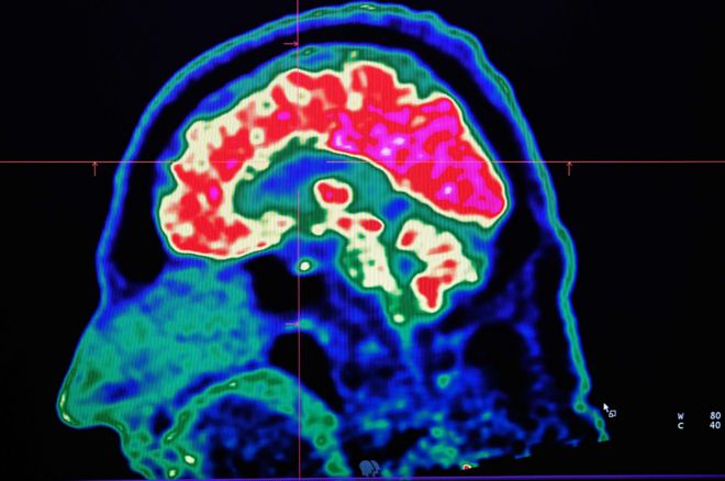 Молекулярное изображение мозга человека, полученное с помощью сканера позитронно-эмиссионной томографии (ПЭТ) в Университетском госпитальном центре Бреста во Франции