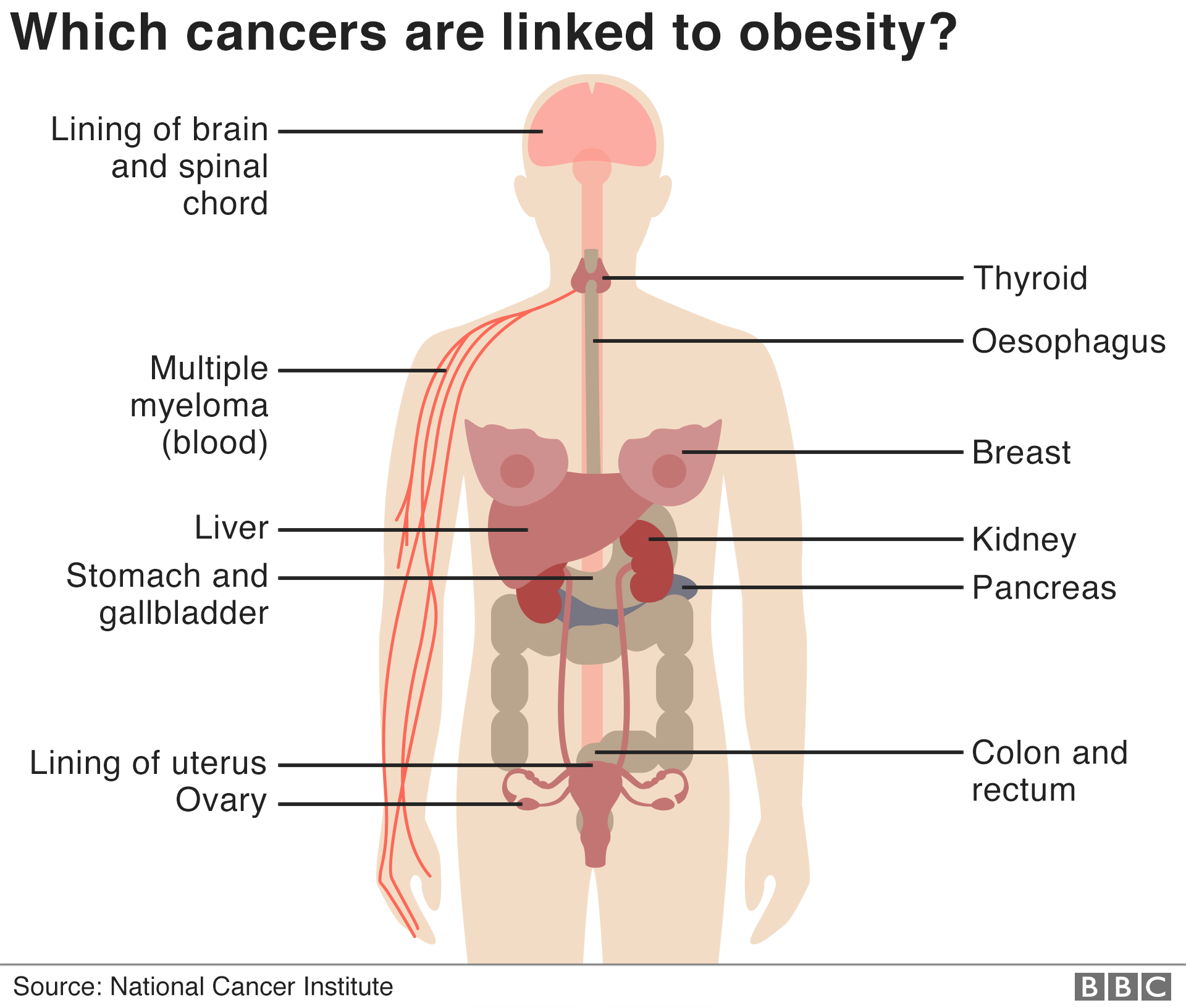 Инфографика показывает женское человеческое тело и указывает части тела, где ожирение связано с раком