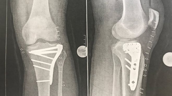 Рентгенография ноги Ричарда Хаммонда