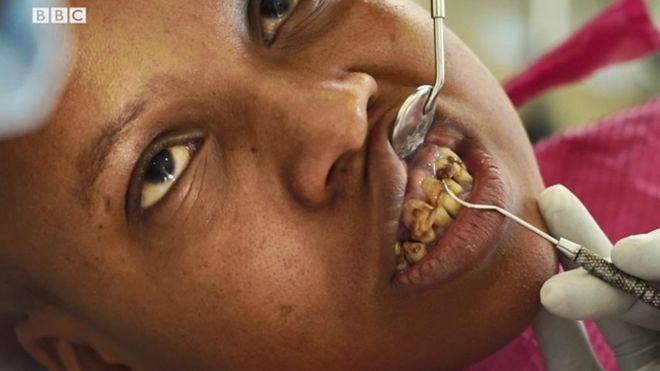 La fluorose dentaire: "Je veux sourire sans honte"