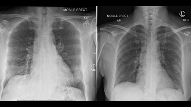 胸部扫描显示患者的肺部情况：第5天（左）和第10天（已好转）