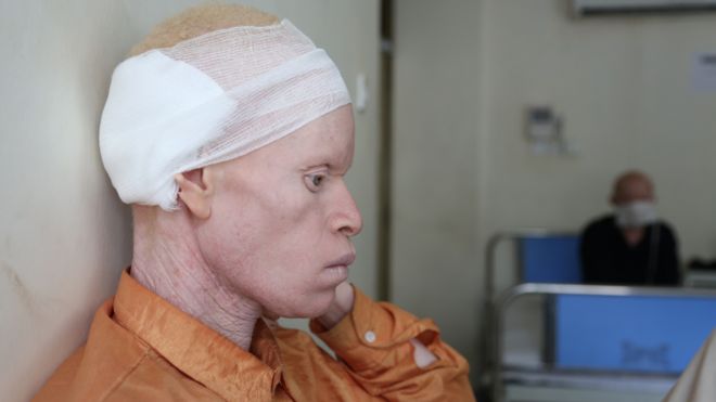 Больной раком с альбинизмом в онкологическом отделении Ocean Road в Дар-эс-Саламе