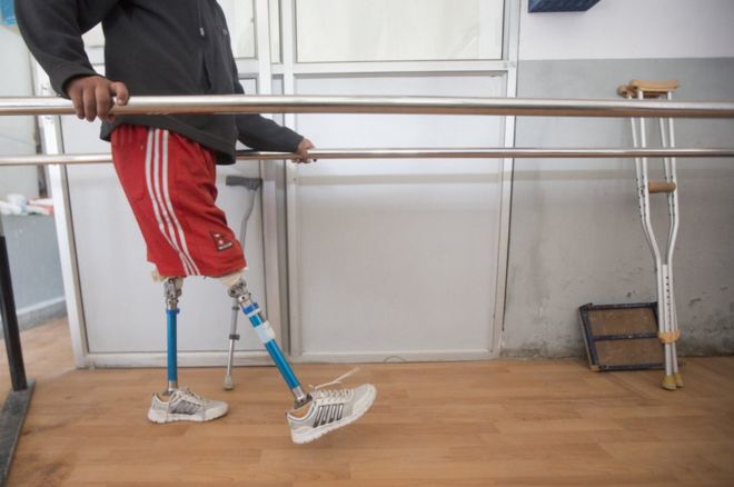 Рамеш использует дорожку в клинике Национального фонда инвалидности в Катманду, чтобы тренироваться по его протезированию