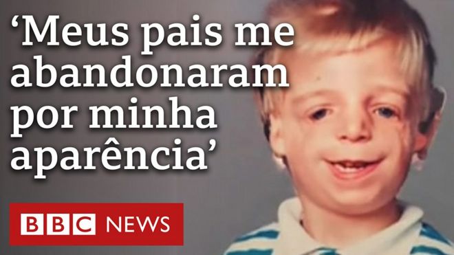 Jono Lancaster foi rejeitado pelos pais e sofreu para se reconciliar com sua própria aparência; agora, ele lança um livro contando sua história.